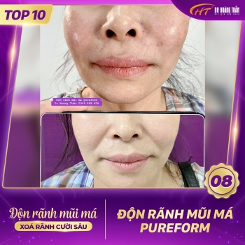ĐỘN RÃNH MŨI MÁ